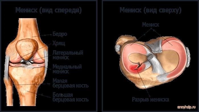 Как получить военный билет с разрывом мениска