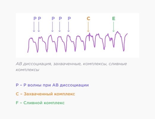 Мономорфная желудочковая тахикардия: характеристики и диагностика