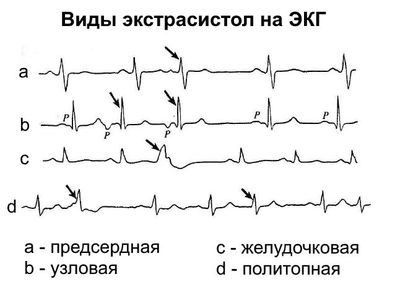 Желудочковая тахикардия: полиморфная и мономорфная формы