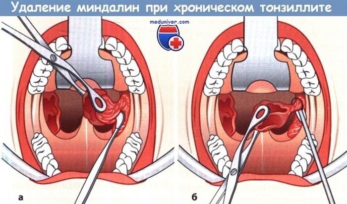 Местные проявления хронического тонзиллита