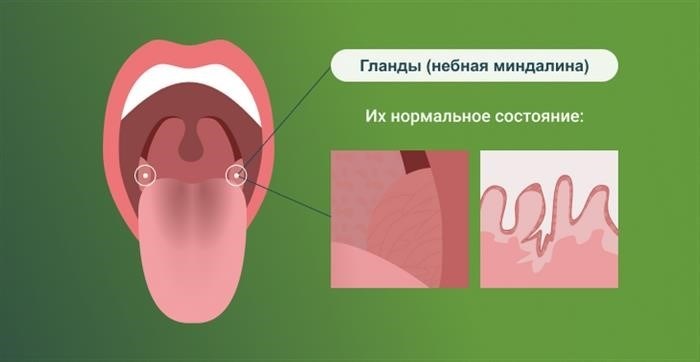 Клиническая картина при хроническом тонзиллите