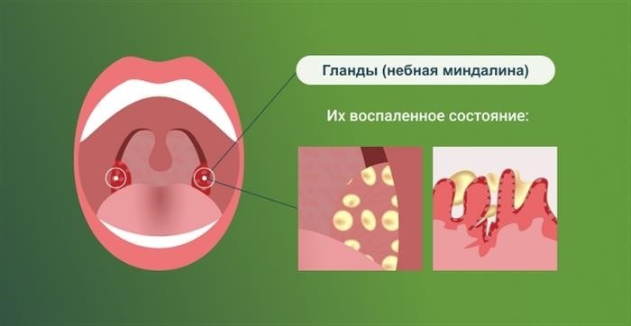 Диагностика хронического тонзиллита