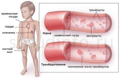 Выработка антитромбоцитарных антител – путь к иммунной тромбоцитопении