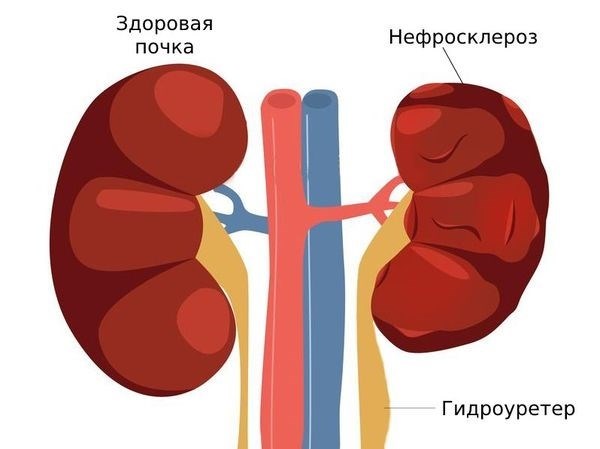 Определение нефроптоза и его симптомы