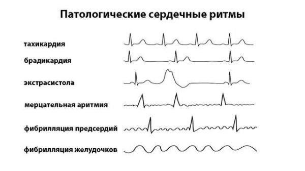 Экстрасистолия и призыв в армию: что говорит закон?