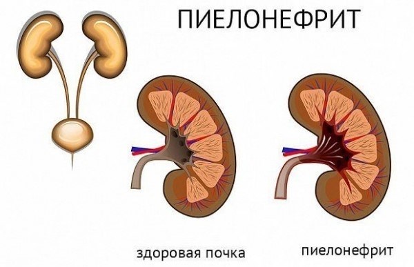 Как влияет пиелонефрит на призыв в армию?