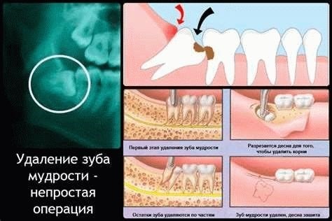 Больничный после удаления зуба мудрости: возможно ли получить