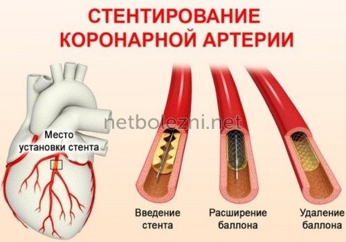 Продолжительность жизни пациентов со стентом